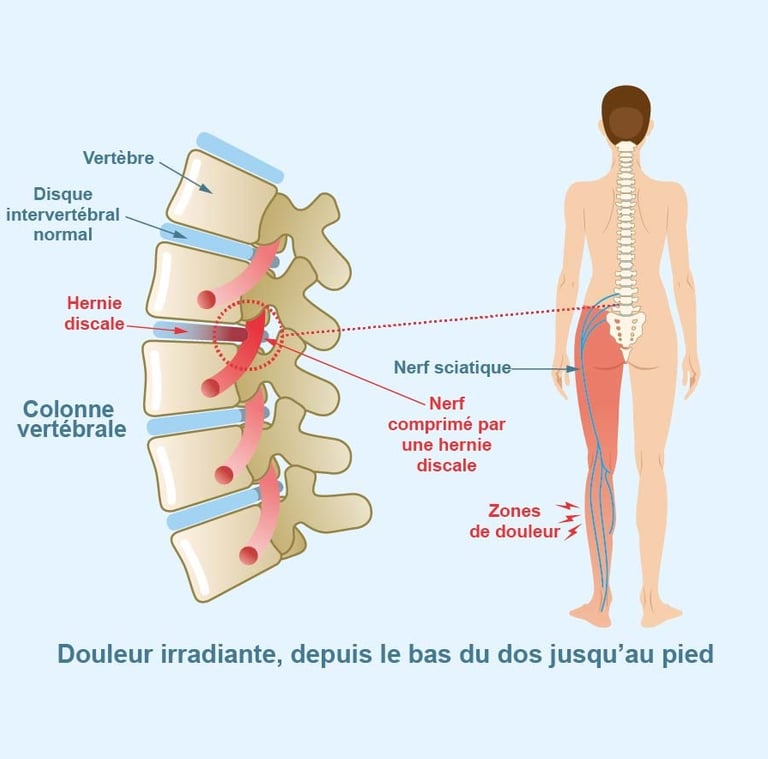 Trajet du nerf sciatique et douleur causée par une hernie discale lombaire