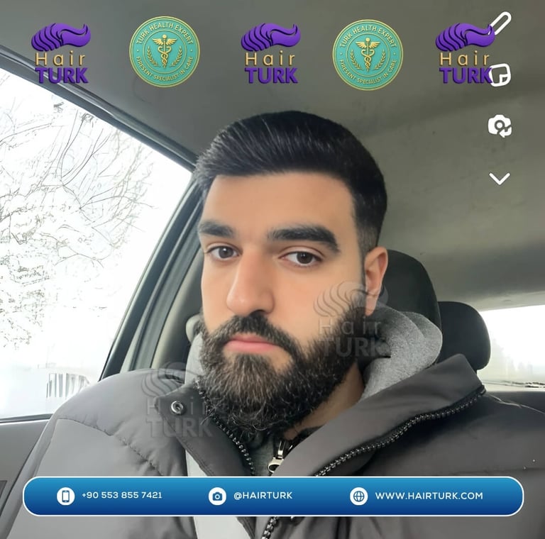 Même patient 10 mois après sa greffe de 3600 greffons, avec une ligne frontale restaurée.