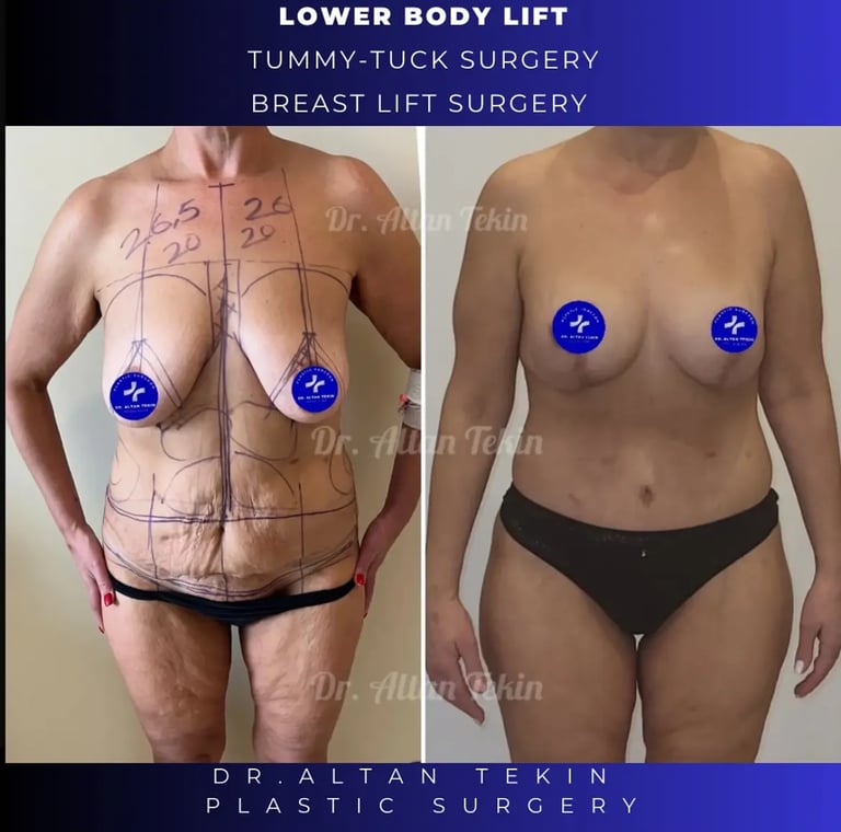 mommy makeover before after photos in Antalya, Türkiye