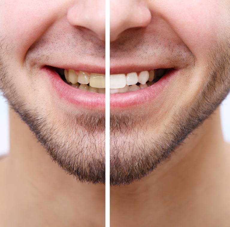 A smiling man with a before and after teeth whitening split image.