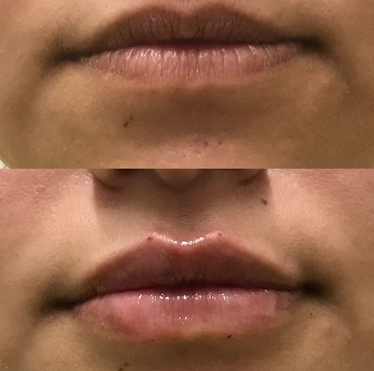 preenchimento de boca