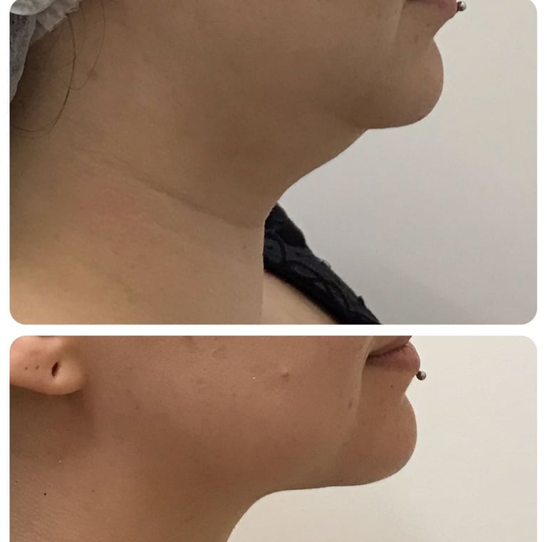 procedimento de papada