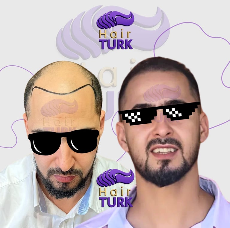 Hair transplant clinic in turkey before after