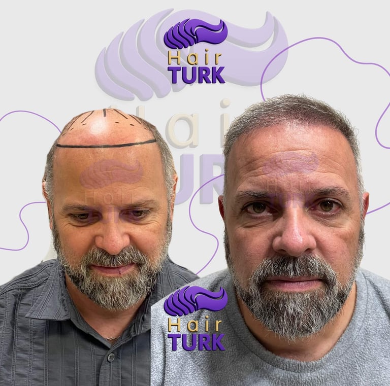 Hair transplant clinic in turkey before after