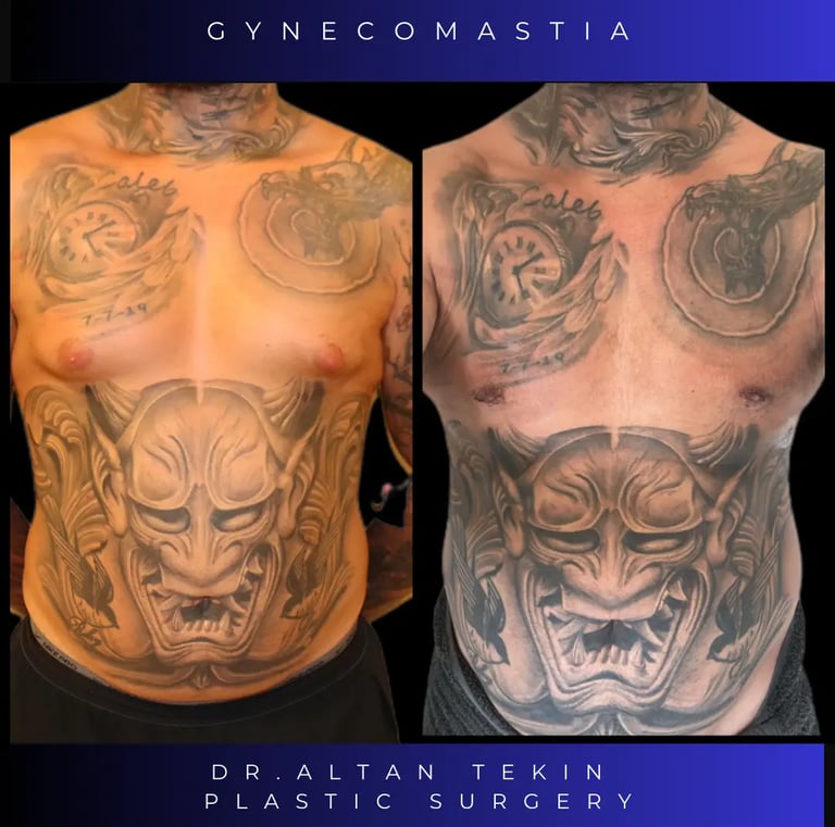 gynecomastia before after photos in Antalya, Turkey