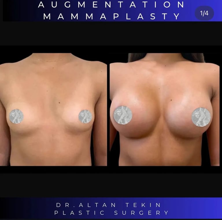 breast augmentation before after photos in Antalya, Türkiye