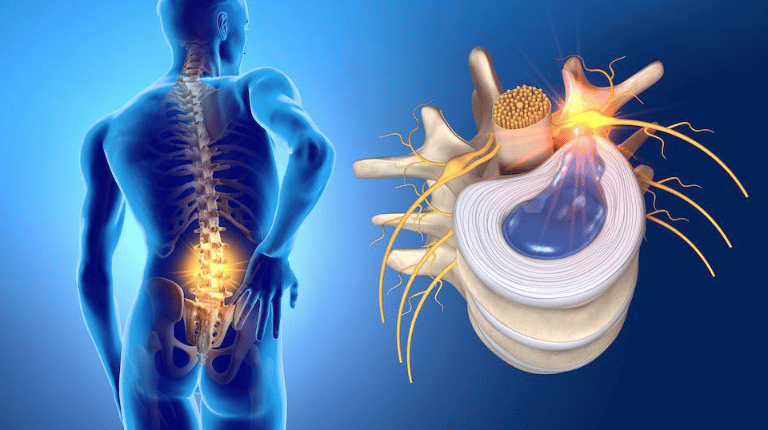 protrusion o hernia discal