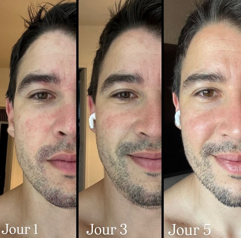Skin résultats en 5 jours