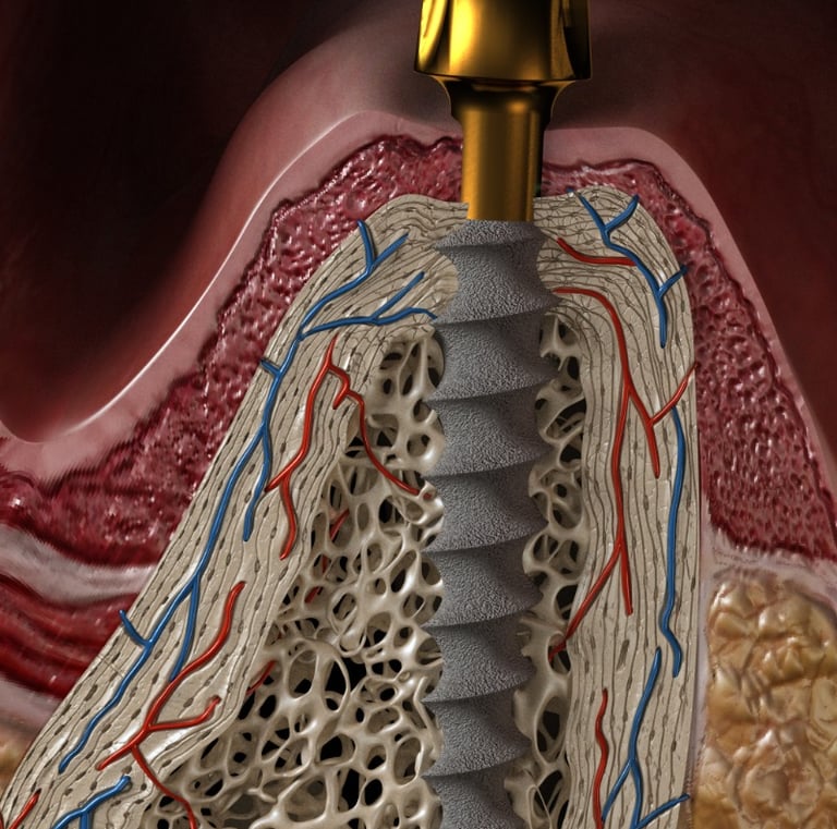 IMPLANTE MONOBLOQUE IDEAL PACIENTES CON POCO HUESO