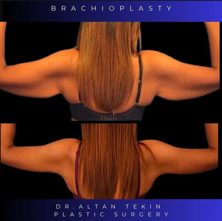 arm lift before after photos in Antalya, Turkey
