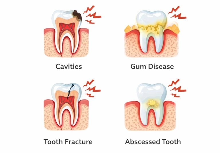 Illustration showing common causes of tooth pain