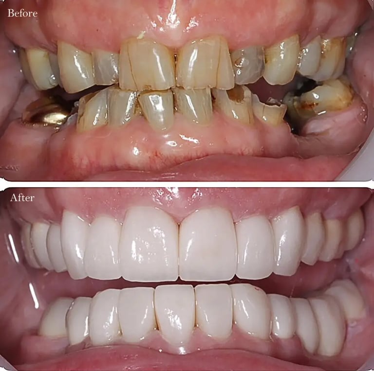 Before and after crowns