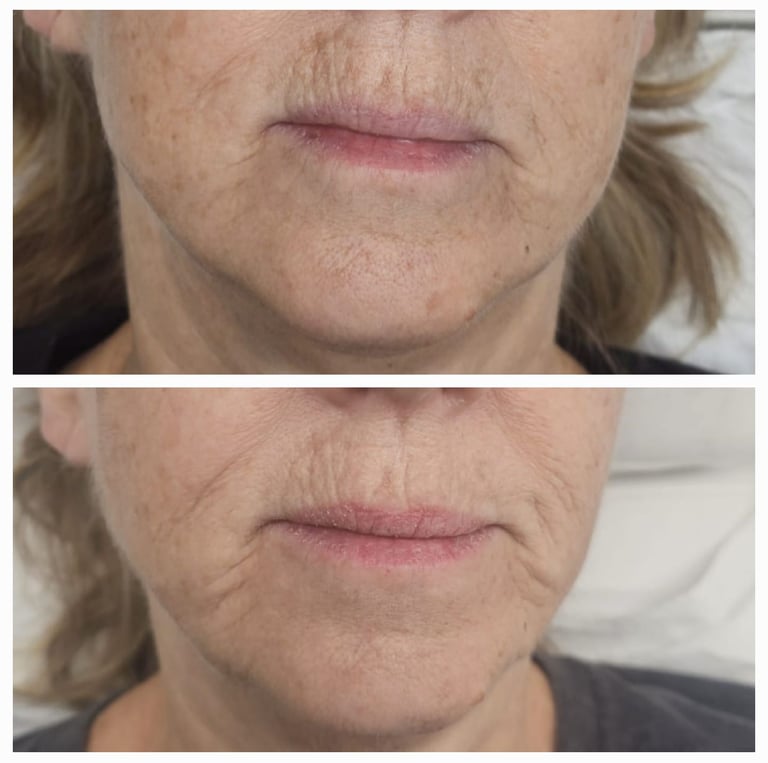 Before and after ResurFX treatment at Ariana Esthetic Edmonton