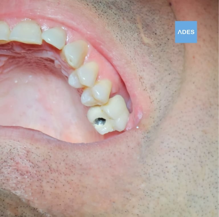 Implantes dentales en Clínica Dental ADES