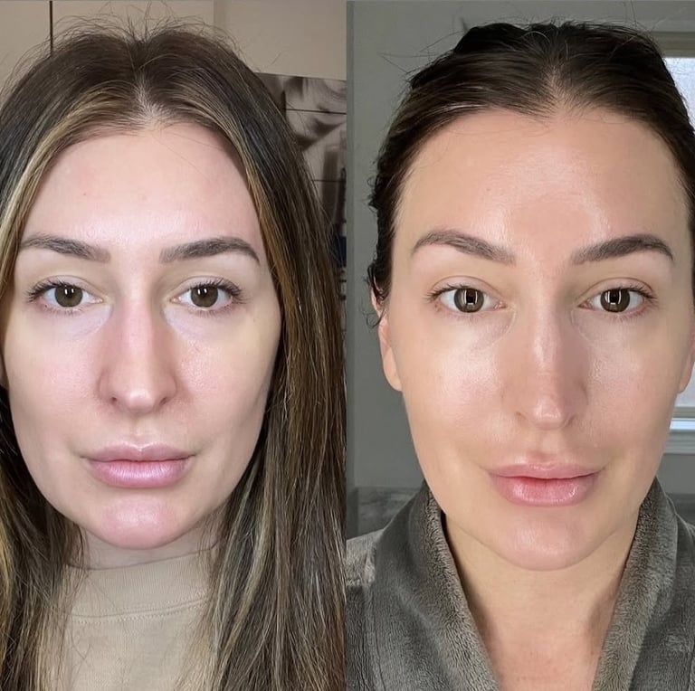 Hydro Facial treatment at Lumina Viso Wokingham
