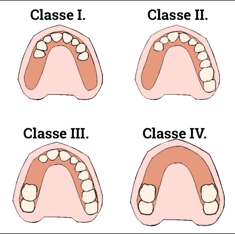 classificação de kennedy resumo classe i, classe ii, classe iii, classe iv