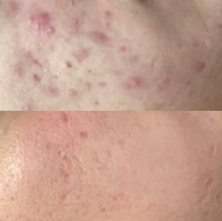 Skin transformation results showing improvement in acne after tailored treatment plan