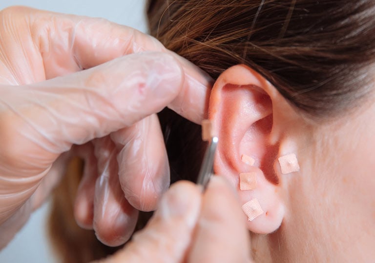 Auriculoterapia