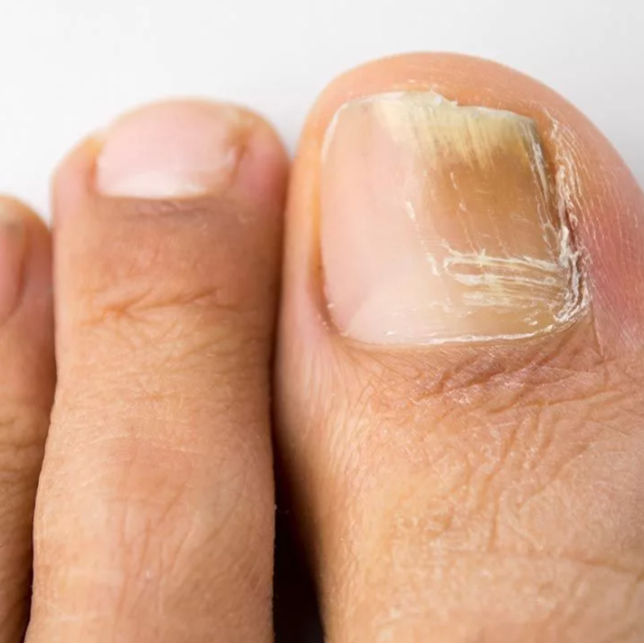 Grybelio pažeistų nagų pedikiūras​ 4522