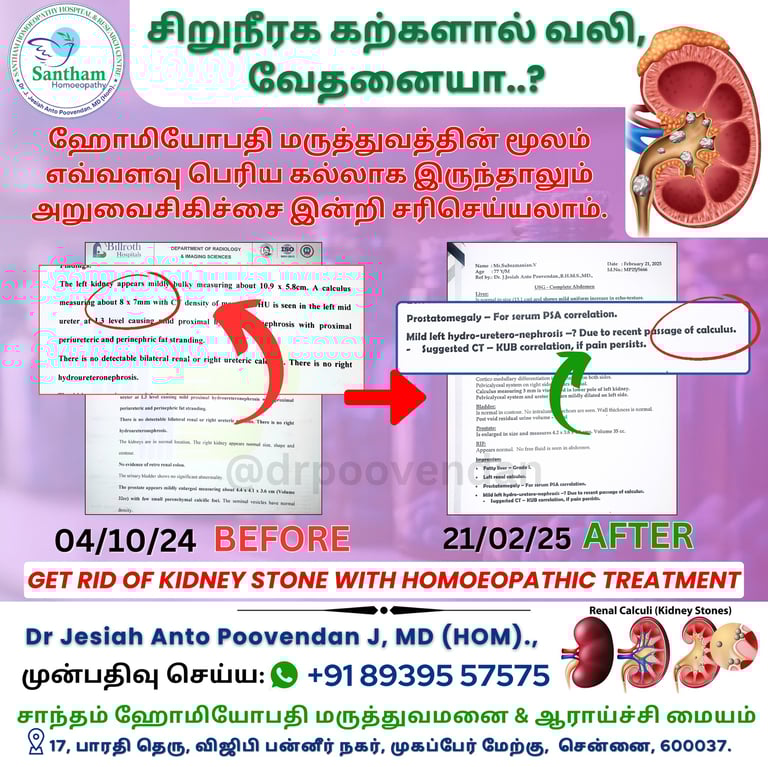 Kidney stone Homeopathic medicine