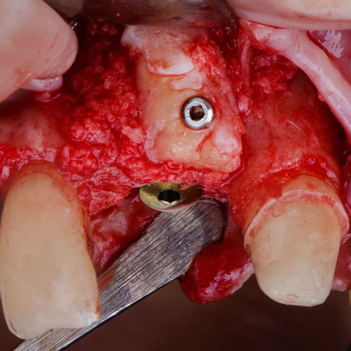 bone graft