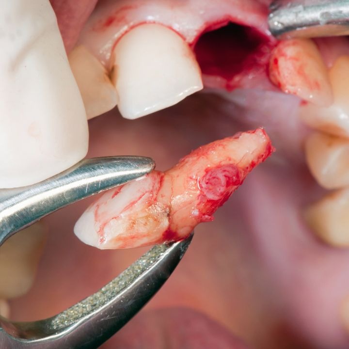 extraction teeth