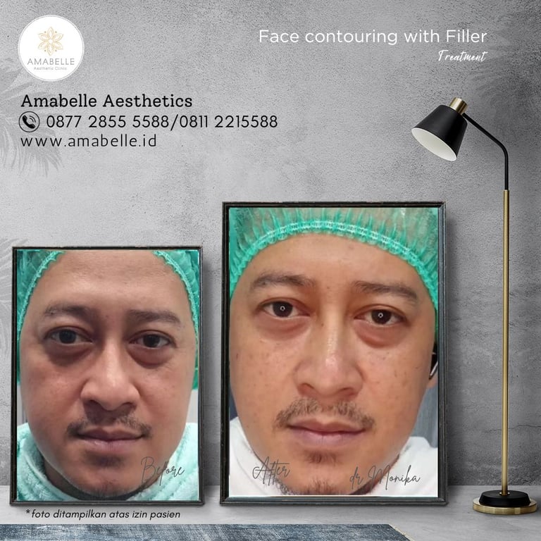 amabelle before after face contouring treatment