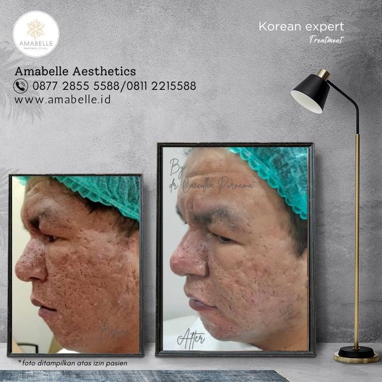 amabelle before after korean expert treatment