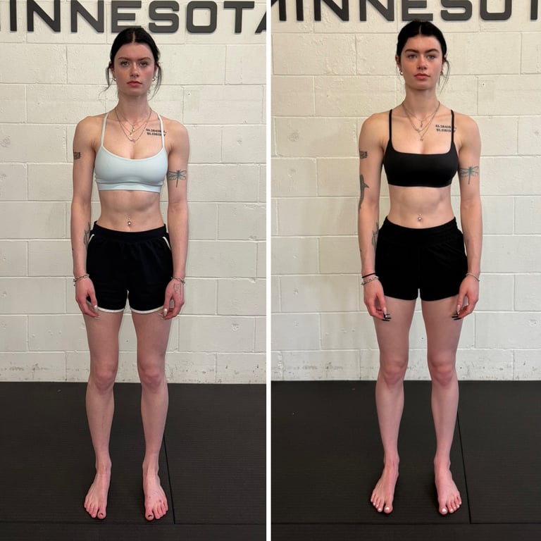 woman with scoliosis demonstrating improved posture and decreased pain in before vs after pictures