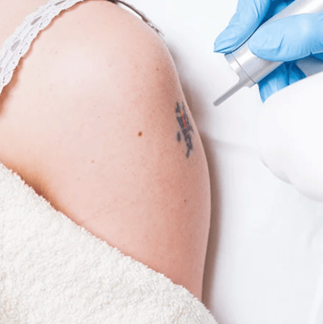 eliminación de tatuajes medianos