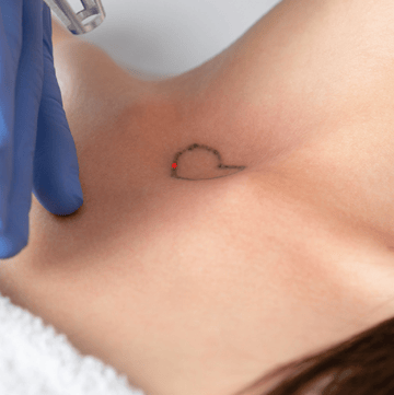 eliminación de tatuajes pequeños