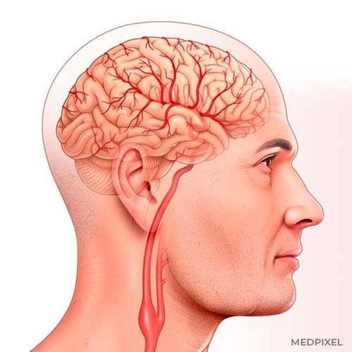 ilustracao medica neuroanatomia mostrando arteria carotida interna comum e cerebro