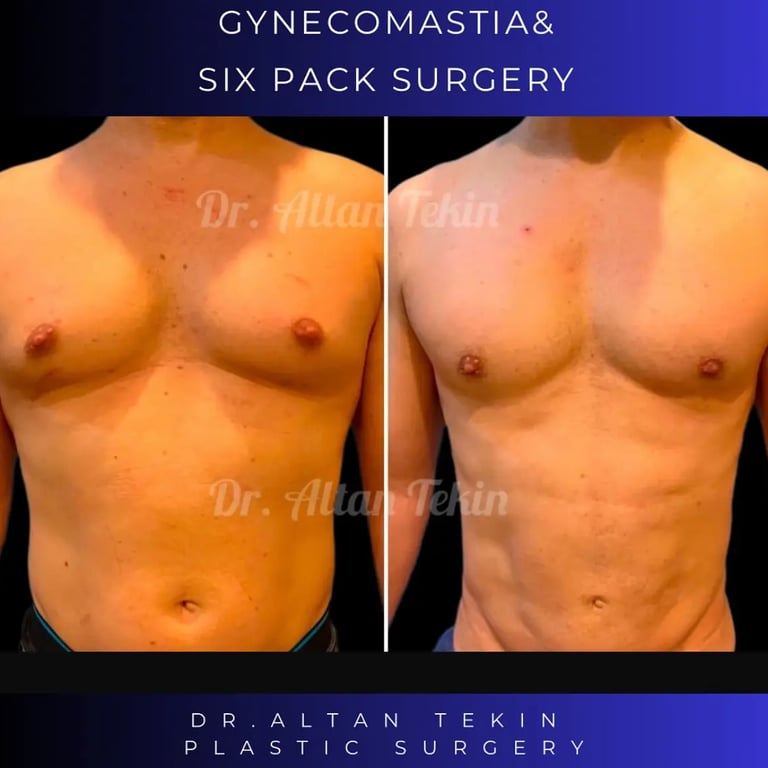 gynecomastia before after photos in Antalya, Turkey.