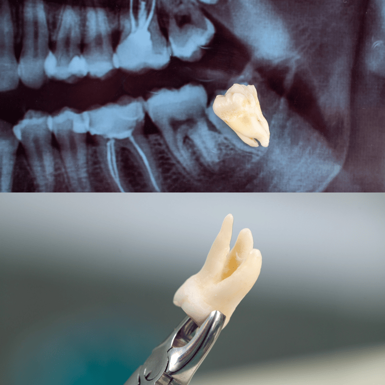 best wisdom tooth extraction | Ekdantam Dental Clinic kopar khairane
