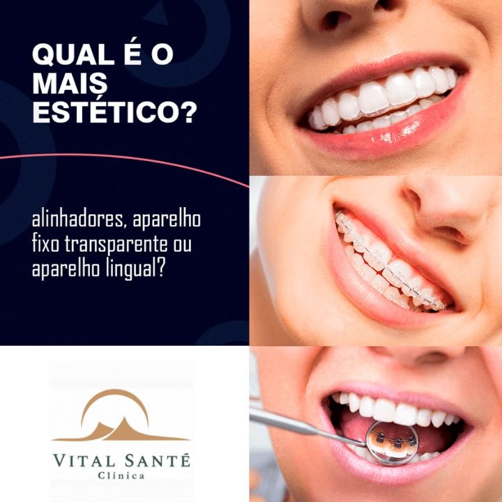 Aparelho dentário estético - invisível, fixo transparente e aparelho lingual