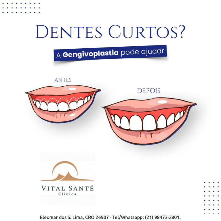 gengivoplastia recreio, dentista no recreio, dentistas no recreio