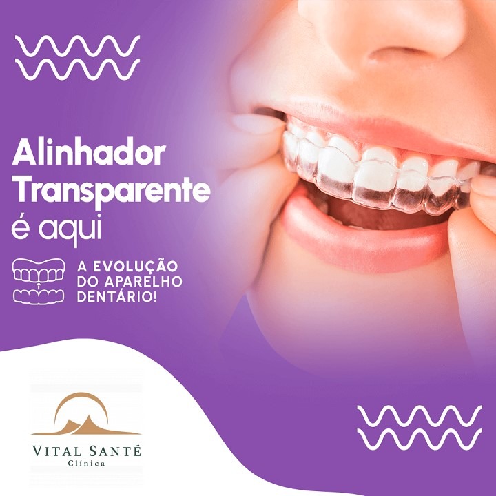 aparelho invisível recreio, alinhador invisível recreio, aparelho transparente recreio 