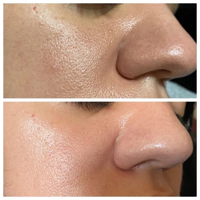 Microneedling treatment results in Coulsdon at SB Studio