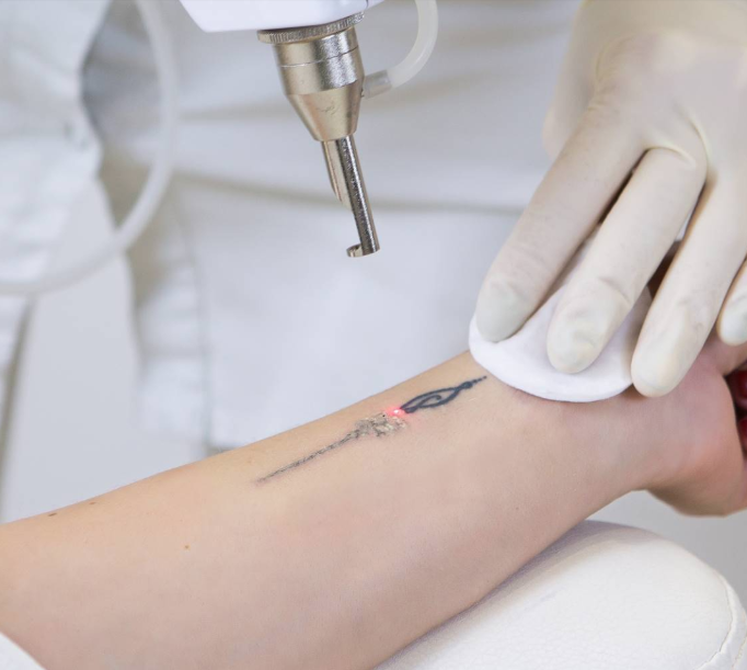 eliminación de tatuajes grandes