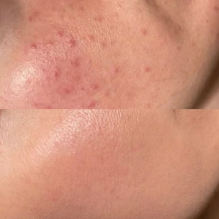 Before and after results from personalised acne skin transformation journey