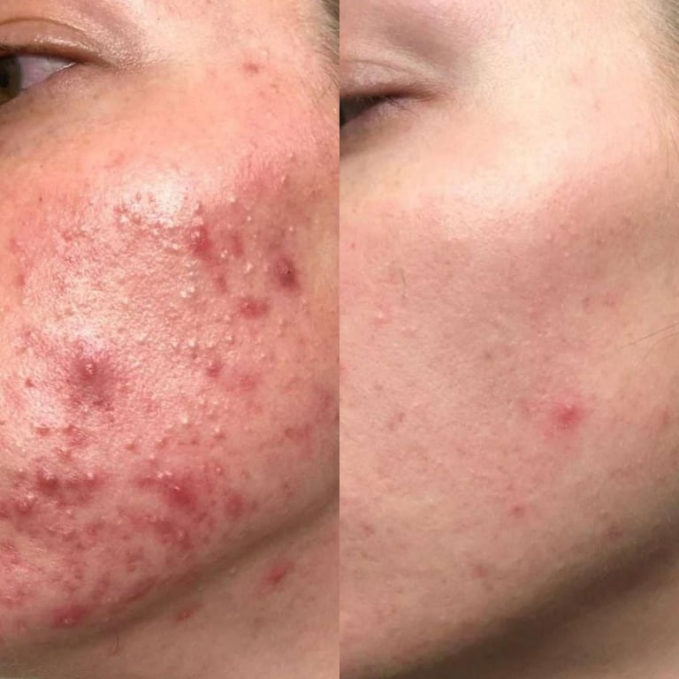 Client skin transformation after acne treatment with Emily Britten UK acne specialist