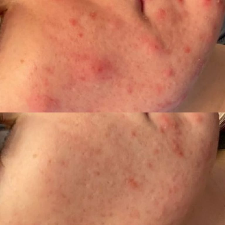 Clear skin results achieved through acne treatment journey with Emily Britten
