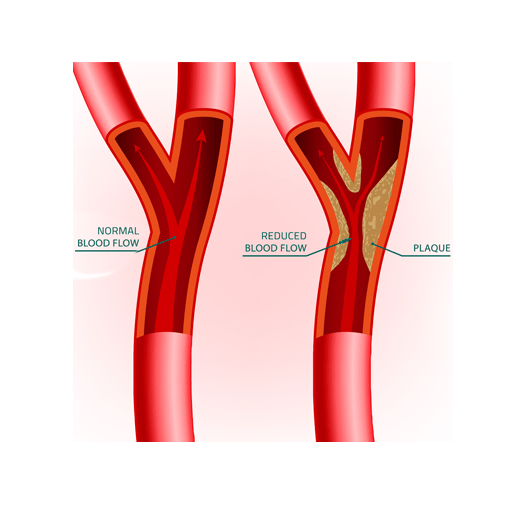 vascular ultrasound artery atherosclerosis stenosis disease stent carotid doppler stroke tia vision dizziness headache plaque