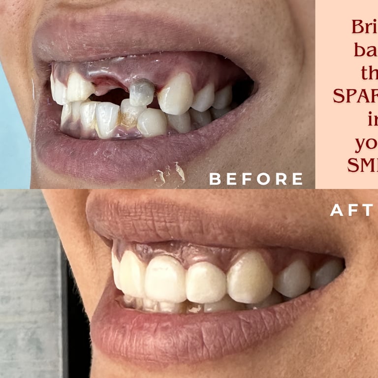 replacing missing teeth with ceramic bridge in malad mumbai