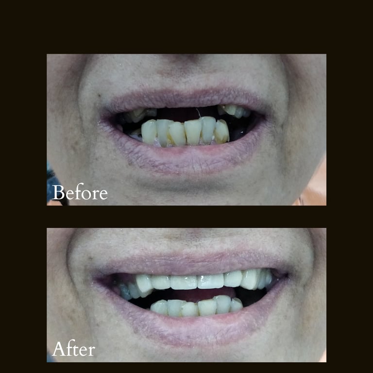 Ceramic Caps with dental implants used for replacing missing front teeth giving beautiful smile