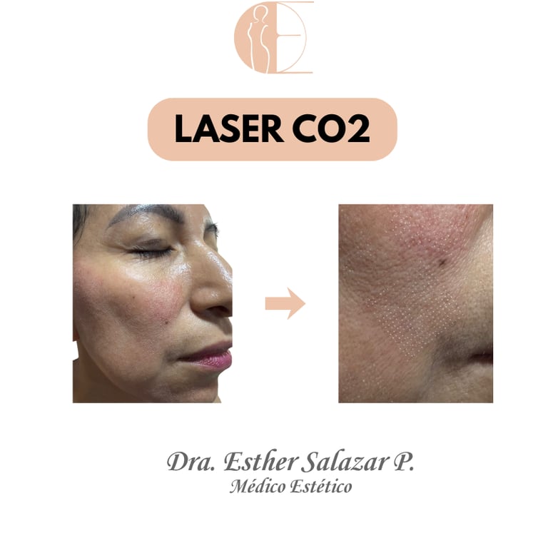 LASER CO2 GUAYAQUIL