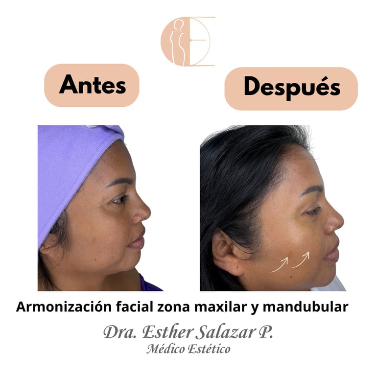 Armonización facial zona maxilar y mandubular