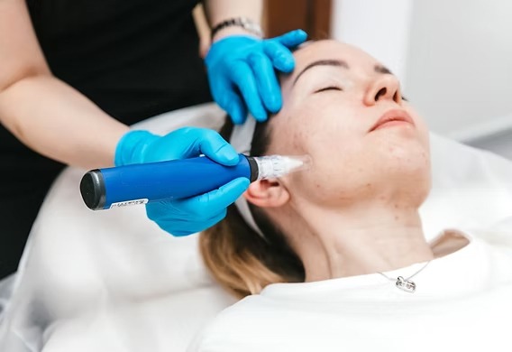 Microneedling treatment for acne and skin rejuvenation performed by a doctor