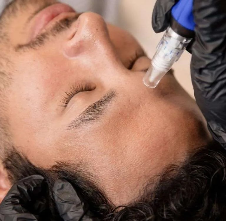 microneedling facial treatment for a man, targeting acne scars and improving skin texture