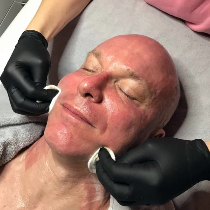 Face after microneedling treatment, showing temporary redness